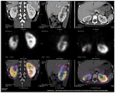 Renal Infarcts—A Perplexing Case in the Middle of the COVID-19 Pandemic